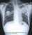 Röntgenaufnahme der Lunge